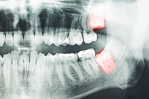 Wisdom teeth and Oral Surgery